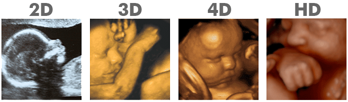 3d 4d ultrasound pictures 12 weeks comparison